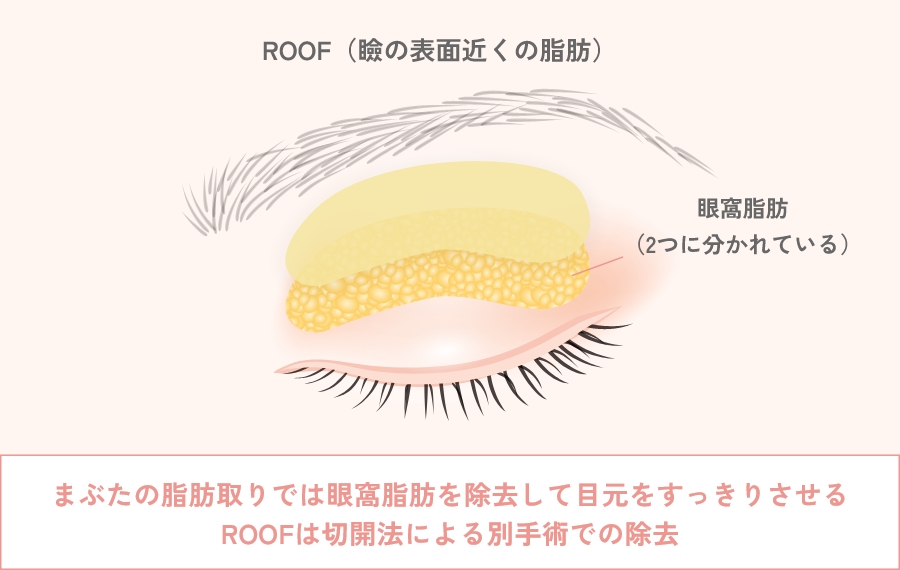 まぶたの脂肪取りとは