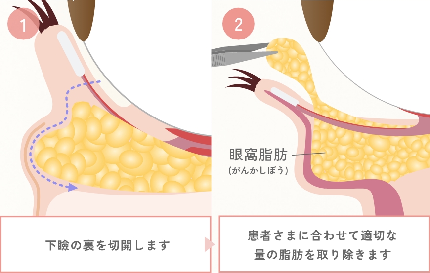 切開方法