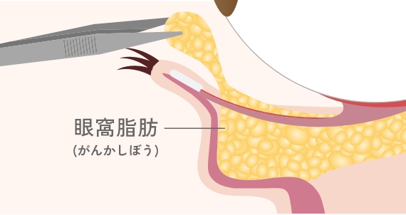 下まぶたの膨らみ取り（経結膜脱脂術）