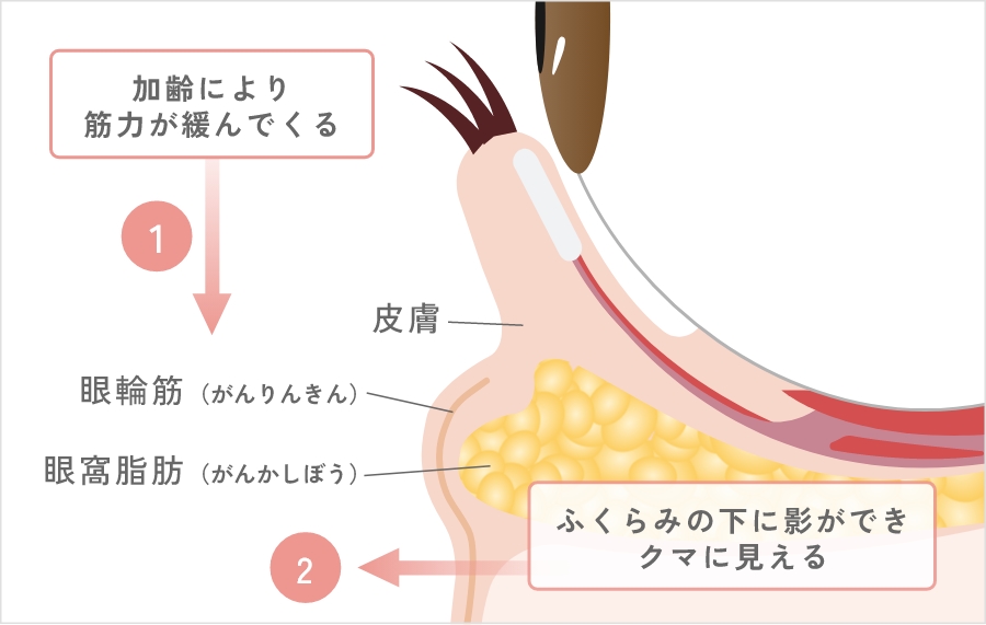 目の下にふくらみやクマができる原因