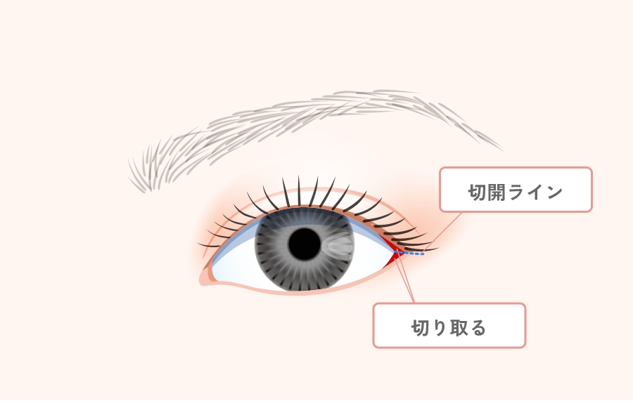 黄金比目尻切開とは