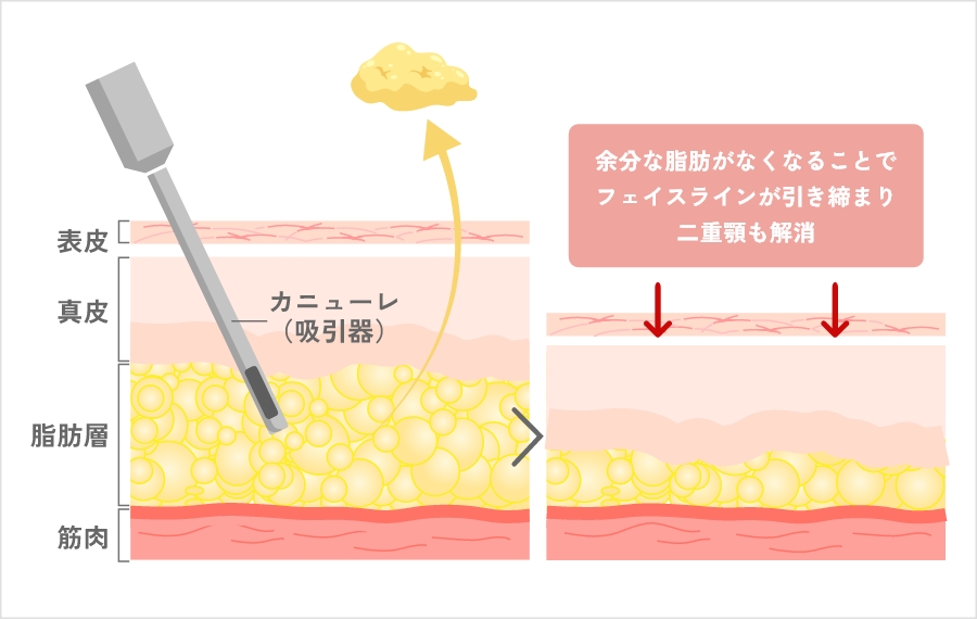 バレない黄金比脂肪吸引とは