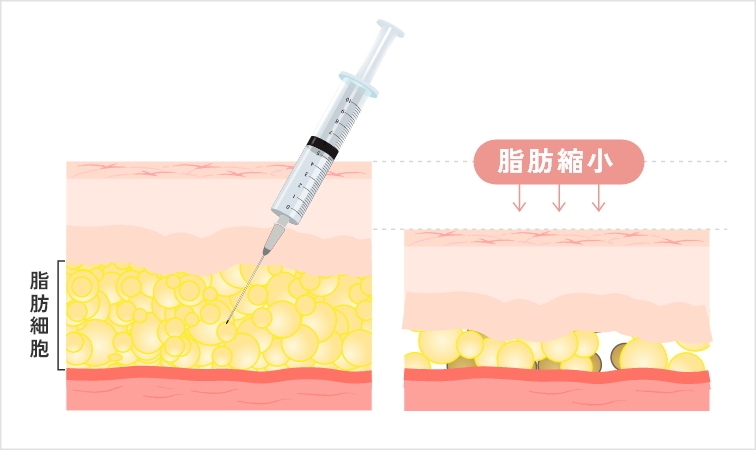 脂肪溶解注射とは