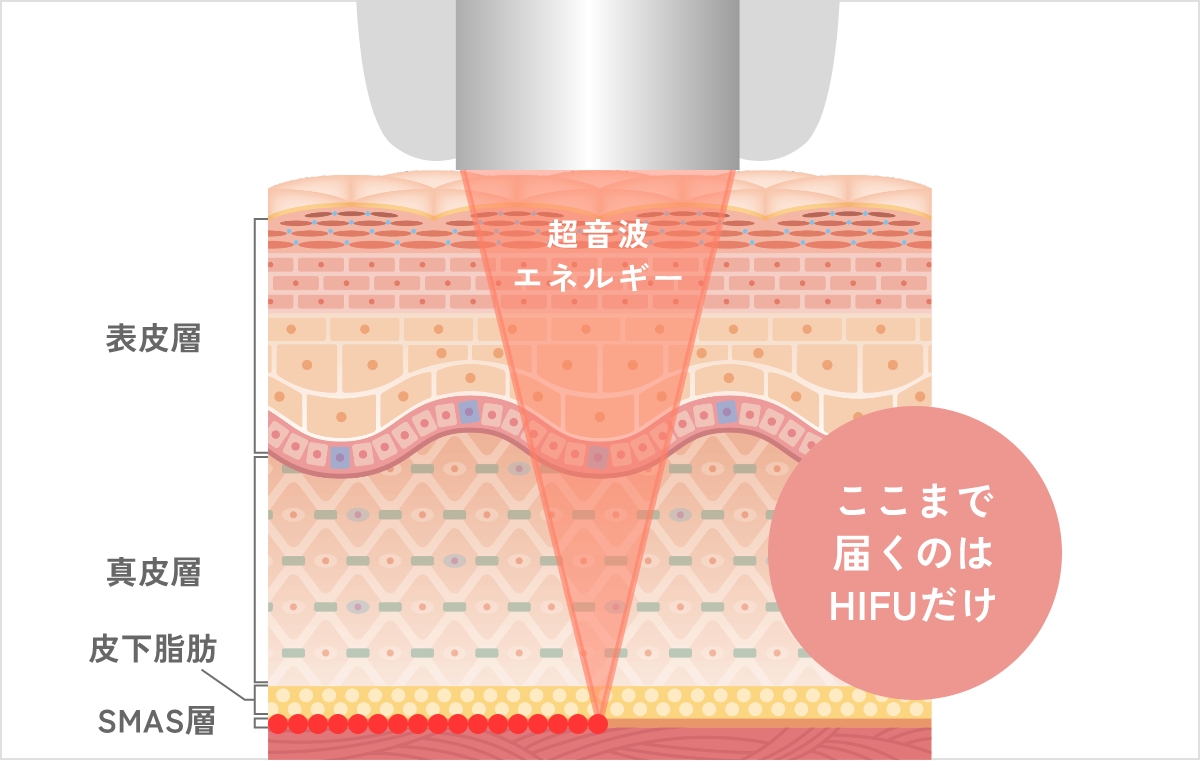 HIFUとは