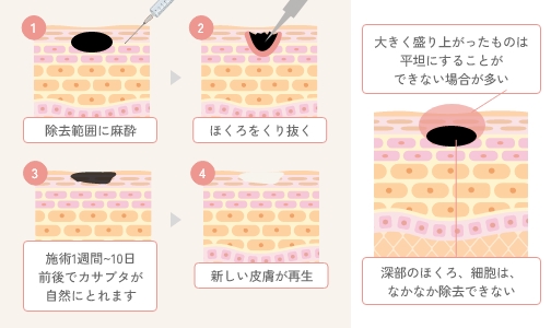 ほくろ除去・いぼ除去とは