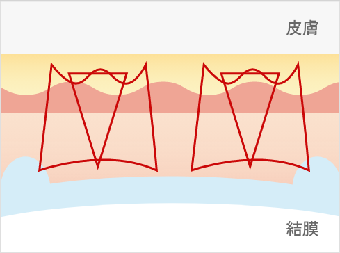 シークレット線留め