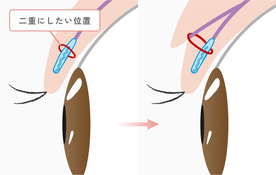 二重整形とは?
