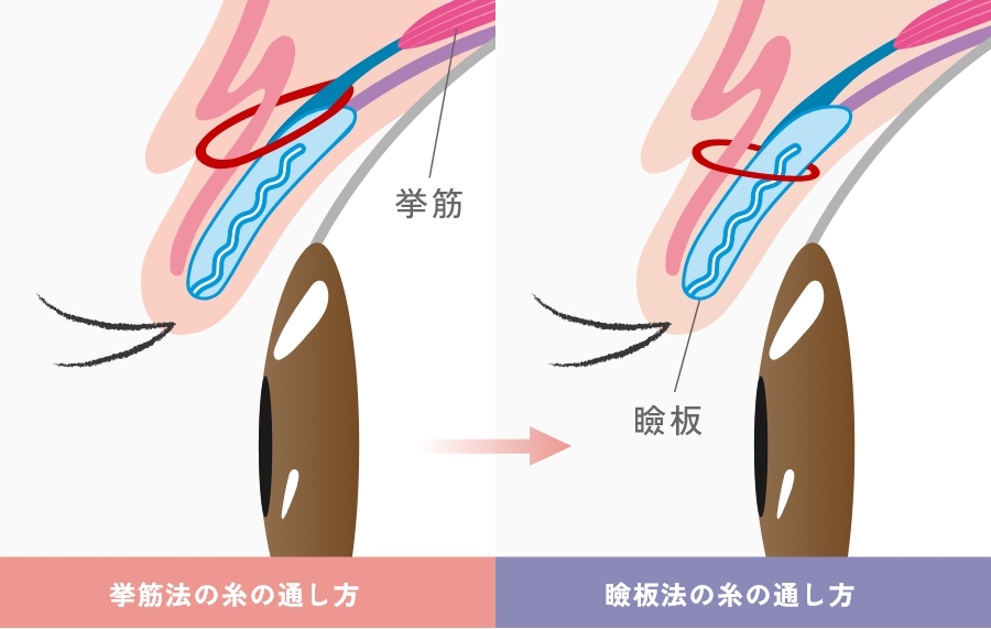 埋没法における挙筋法と瞼板法