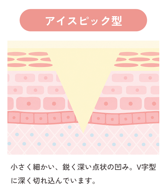 アイスピック型