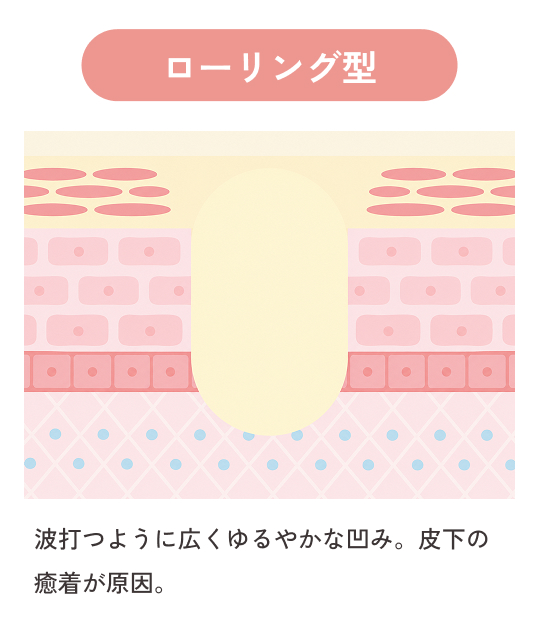 ローリング型