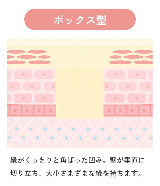 ボックス型