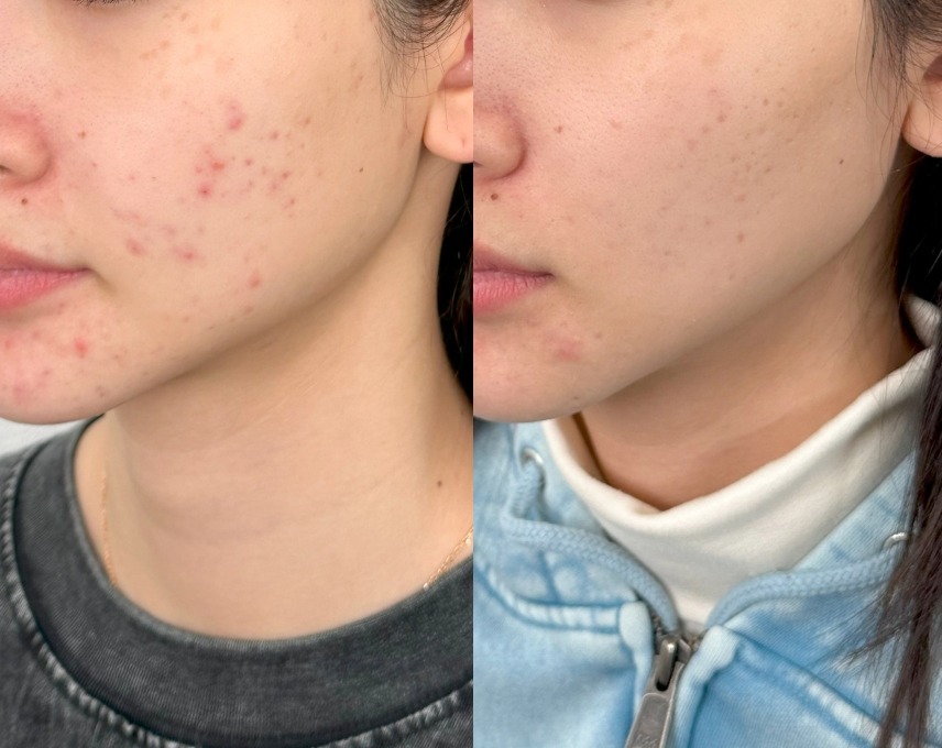 Before-After