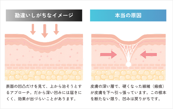 クレーター肌の原因とはとは？