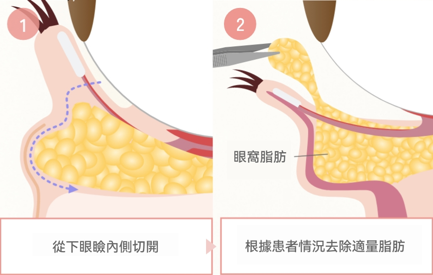 切開方法