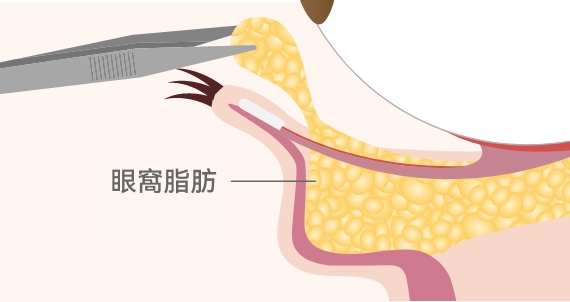 下眼瞼膨出改善(經結膜脫脂術)