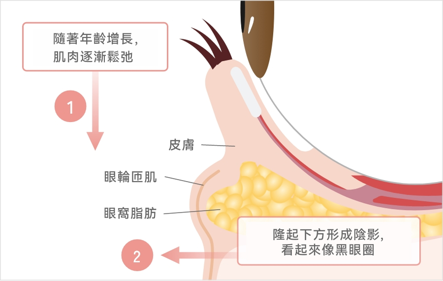 眼下出現膨出及黑眼圈的原因