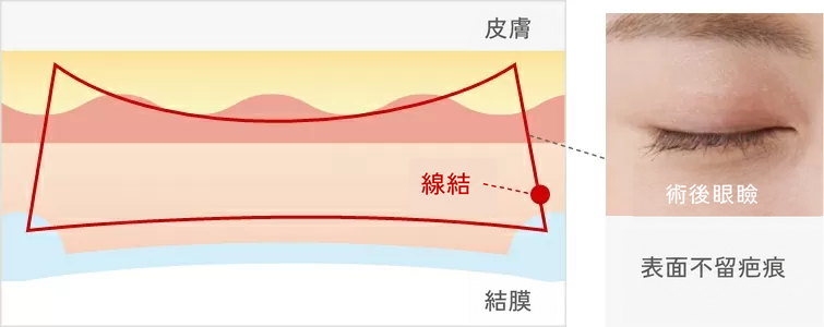 無痕黃金比雙眼皮術