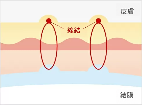 黃金比雙眼皮術