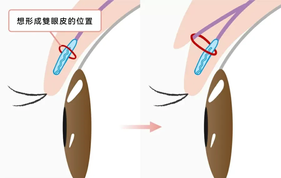 雙眼皮整形是什麼?