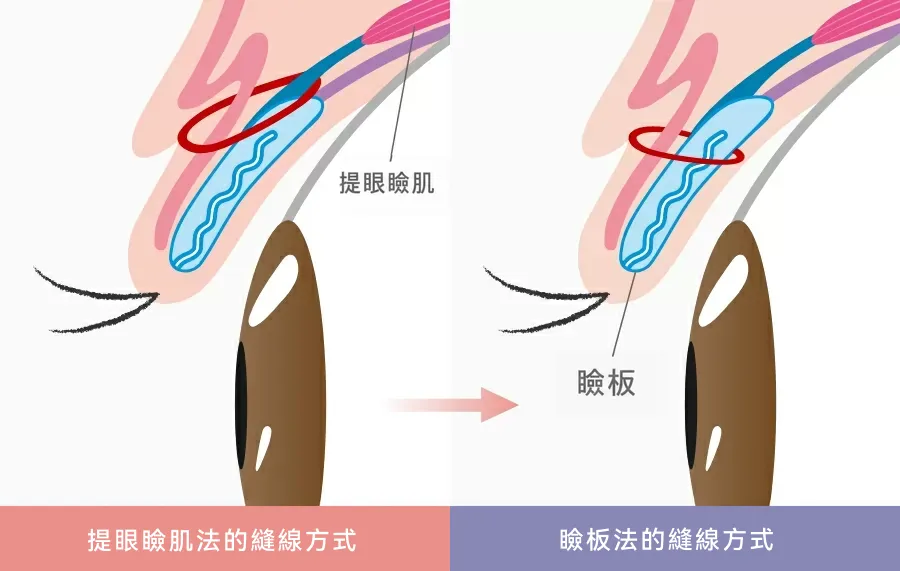 埋線法中的提肌法與瞼板法