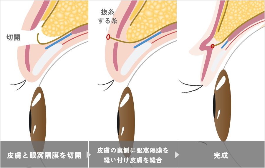 黃金比雙眼皮切開法是什麼