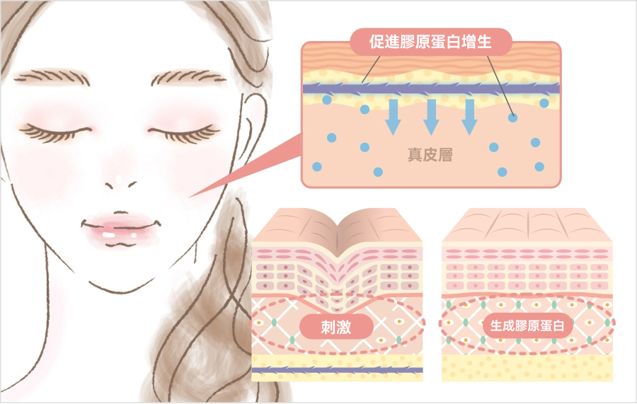 埋線拉提的效果