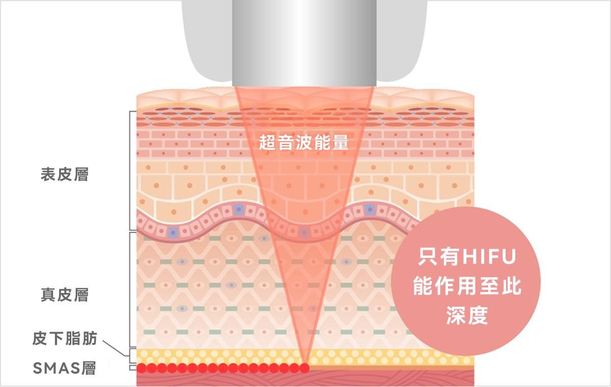 HIFU是什麼
