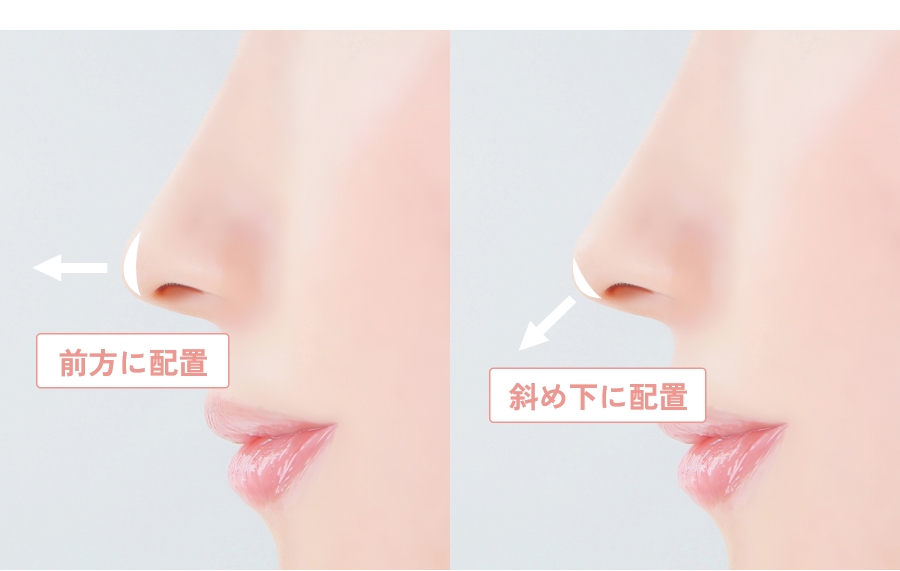 鼻先移植術是什麼