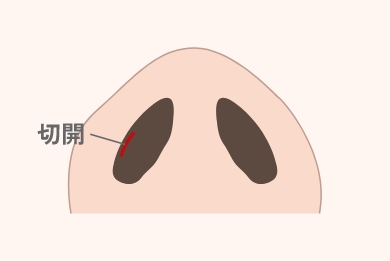 切開