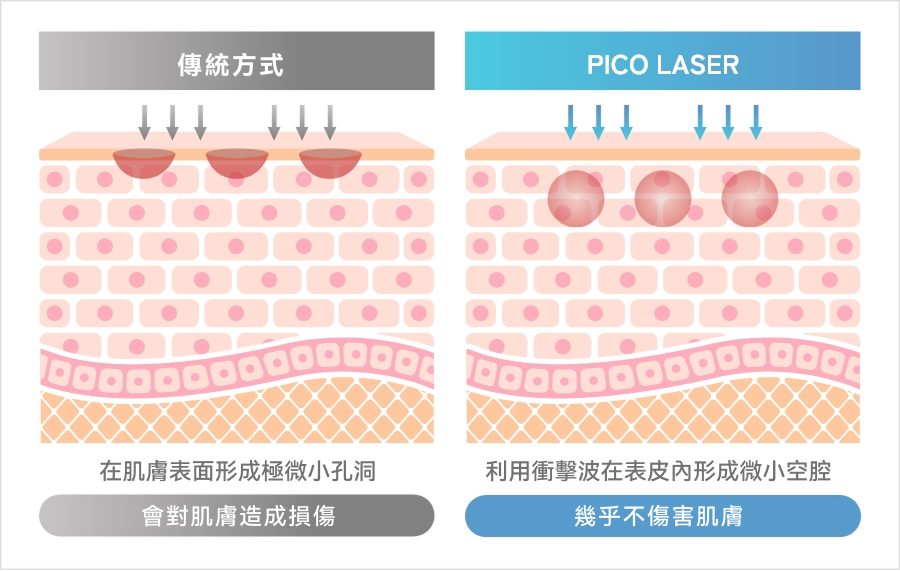 皮秒點陣是什麼