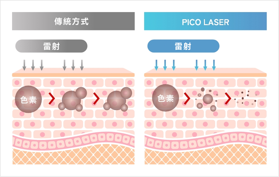 皮秒煥膚是什麼