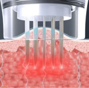 照射RF