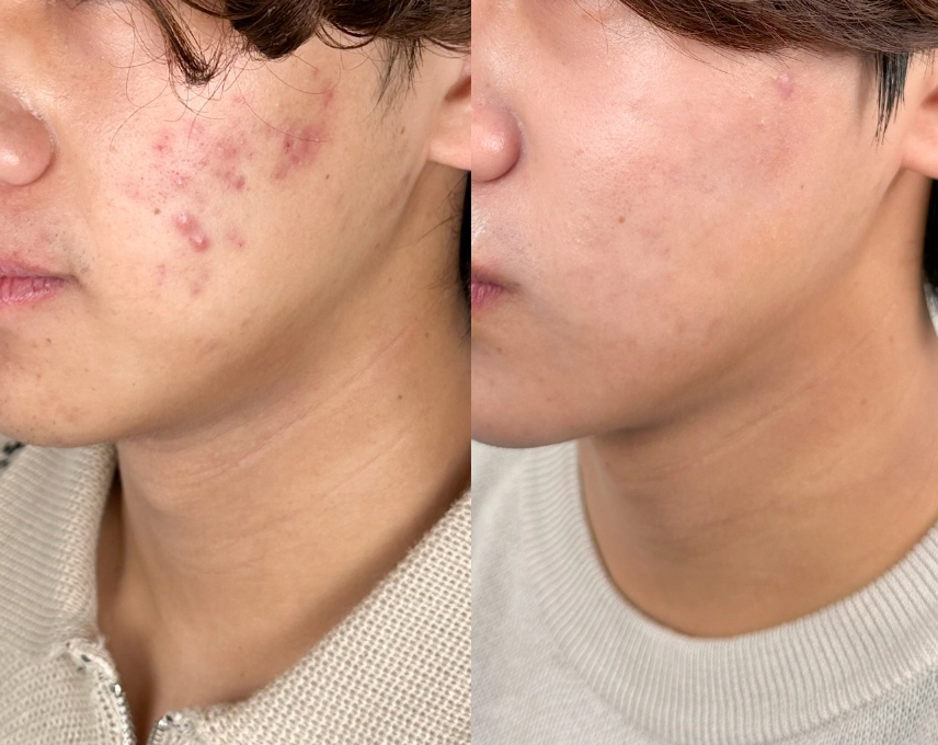 Before-After