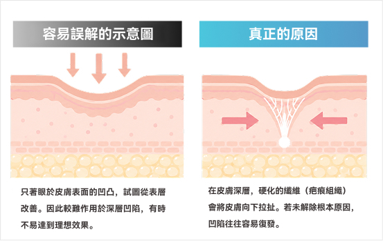 凹洞肌的原因是什麼？