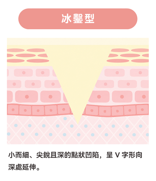 冰錐型