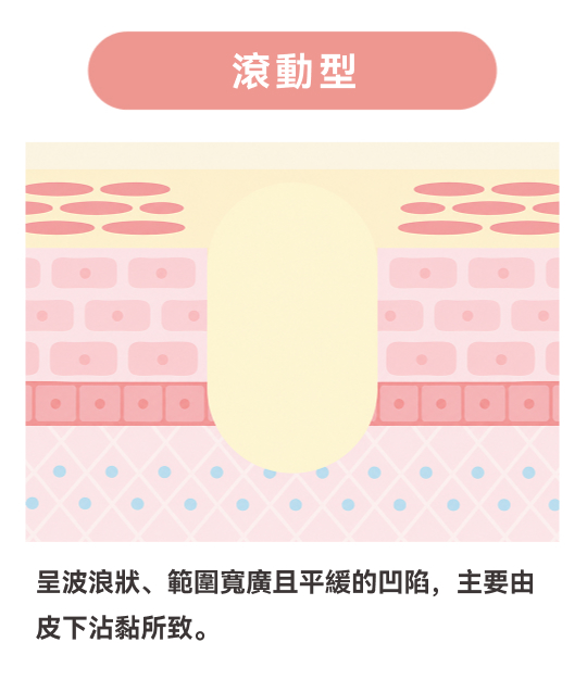 滾動型