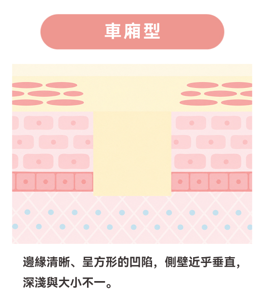 箱型
