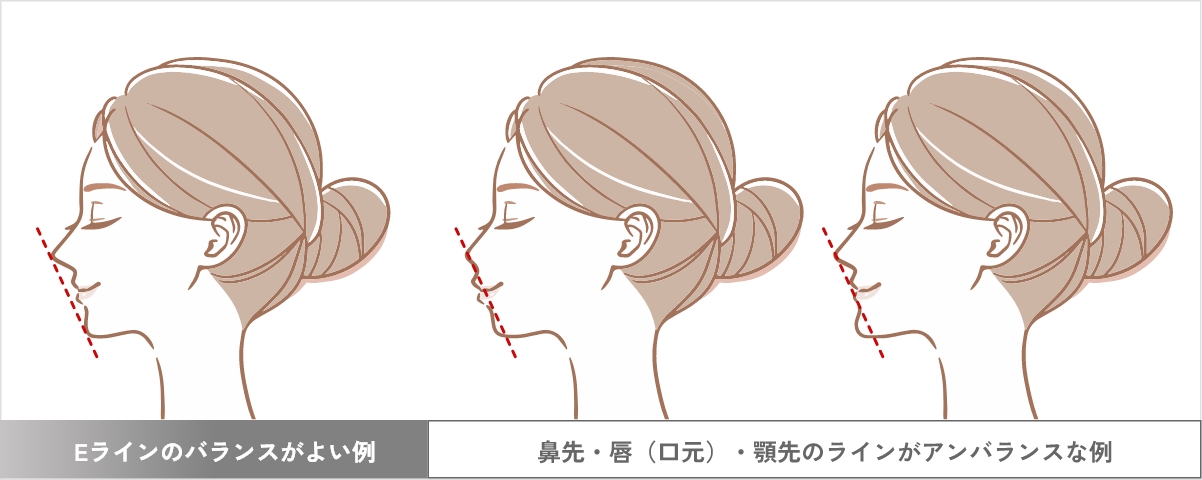 E线比例良好的示例，以及鼻尖、嘴唇（口周）、下巴尖端线条不平衡的示例