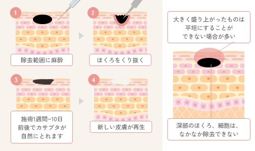 去痣／去疣是什么