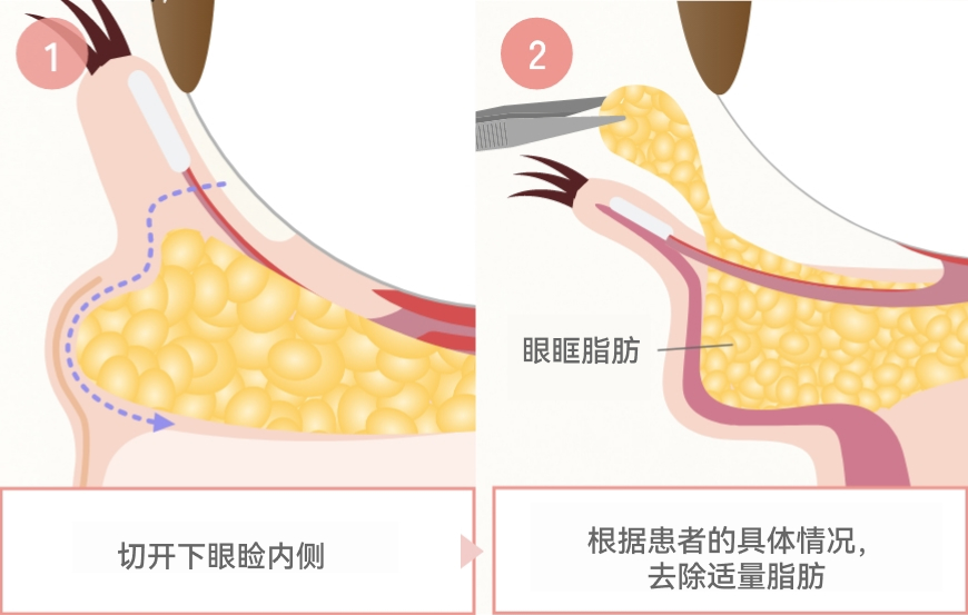 切开方法