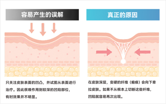凹洞肌的原因是什么？
