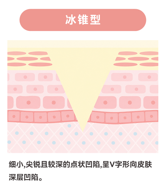 冰锥型