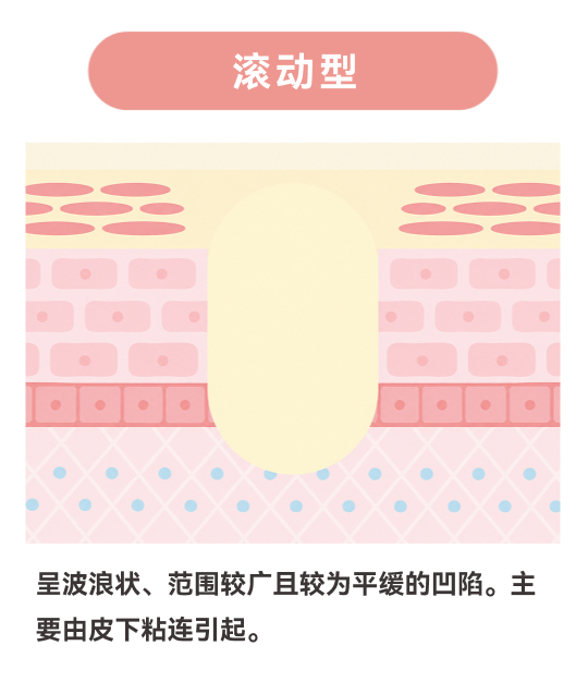滚动型