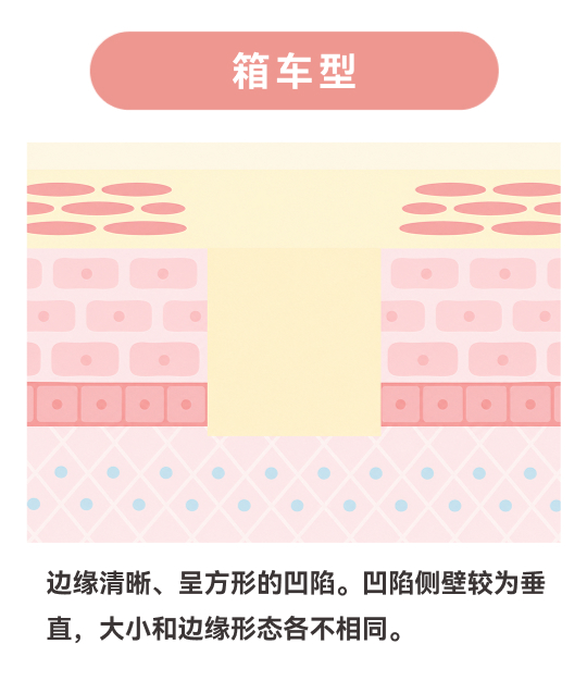 箱型